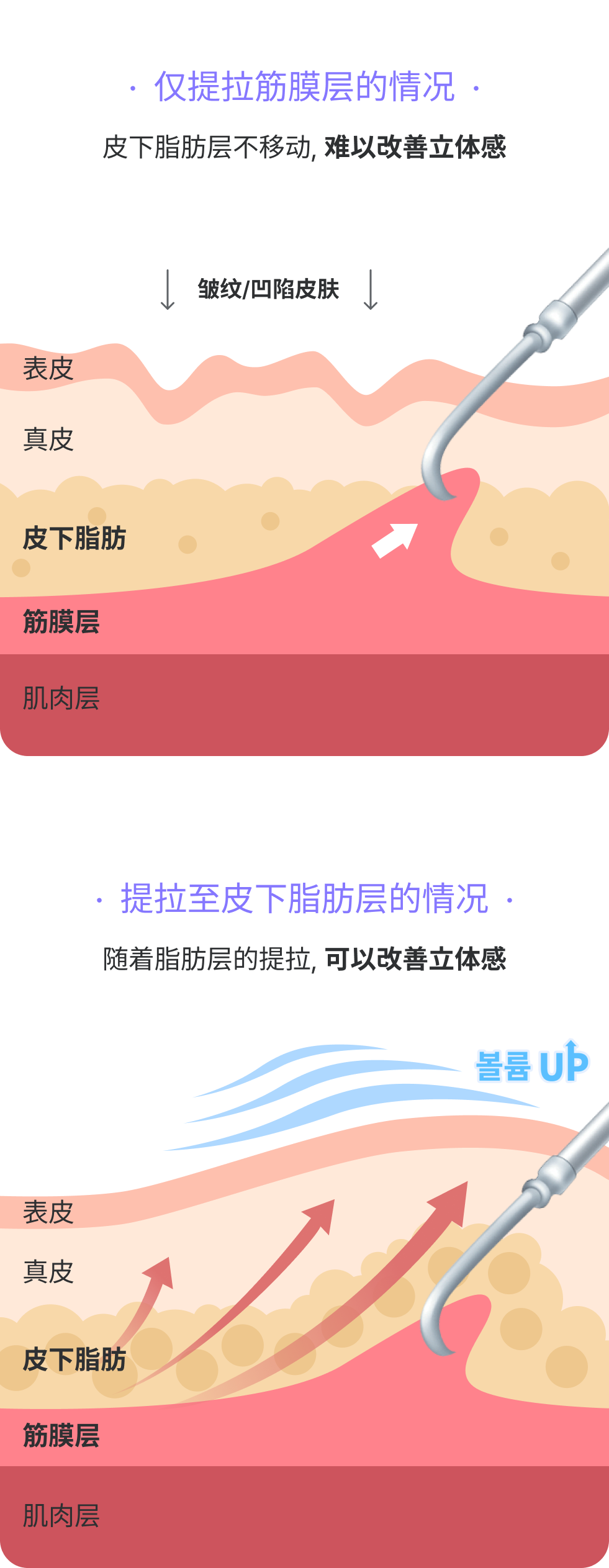 筋膜層だけ引っ張る場合:皮下脂肪層が移動しないため、ボリューム感の改善が困難 シワ/へこんだ肌 / 筋膜層まで引っ張る場合:脂肪層がリフトアップされ、ボリューム改善が可能