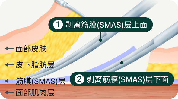 1.筋膜（SMAS）層上の剥離、2.筋膜（SMAS）層下の剥離