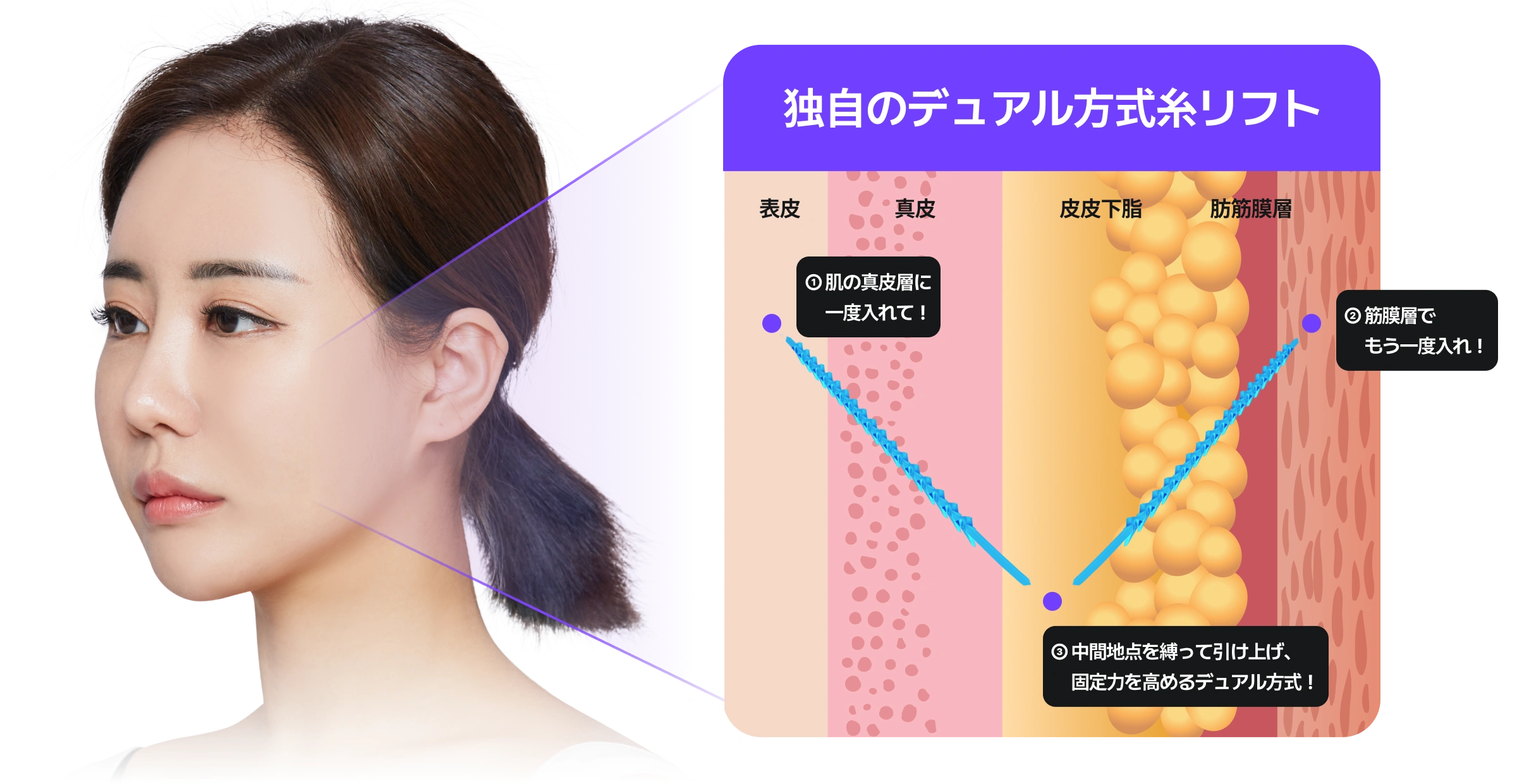 短時間で 強力なリフトアップ効果、NO切開 NO傷跡、抜糸せずに 日常生活への復帰 