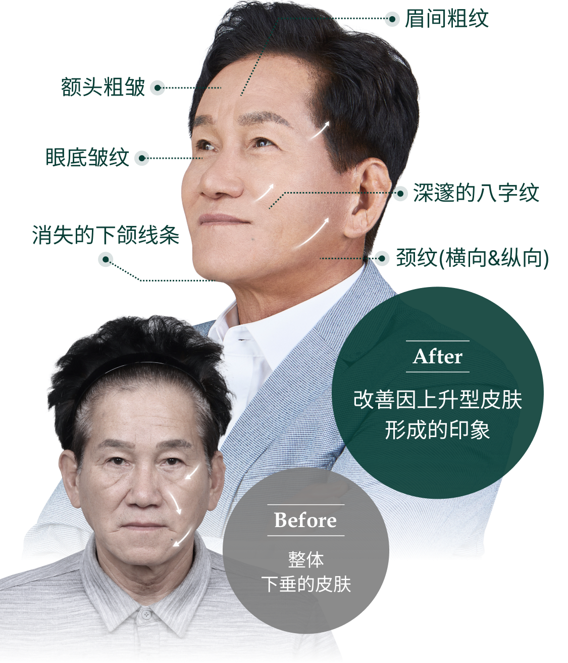 before:全般的に たるみ下がった皮膚, after:上昇型肌による 印象改善